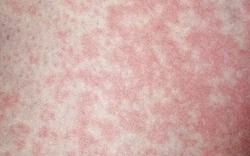 Người đàn ông nhiễm nấm vùng kín vì thói quen nhiều người làm với đồ lót của mình