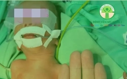 ‘Nhường’ máu nuôi người anh song thai, bé trai sinh non nguy kịch