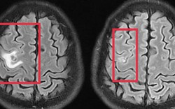 Co giật do sán não suýt nhầm lẫn với u não