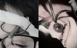 Nguy cơ mất thị lực do móc câu cá cắm vào mắt