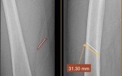 Gắp dị vật kim loại sâu do tai nạn lao động