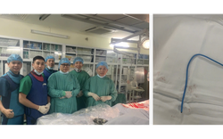 Ống thông truyền hóa chất bị bỏ quên suốt 3 năm, đứt trôi vào tim người phụ nữ