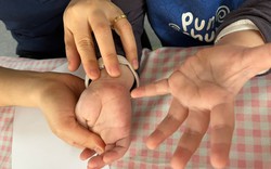 Tưởng con sốt phát ban, bà mẹ tá hỏa khi bác sĩ kết luận tay chân miệng