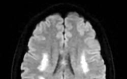 Nữ bệnh nhân đột quỵ bác sĩ chỉ ra nguyên nhân bất ngờ