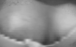 Hoại tử ngực vì tiêm chất làm đầy