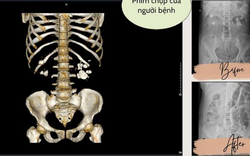 Xem phim chụp CT, bác sĩ "tá hỏa" khi thấy điều không ai ngờ trong thận người bệnh
