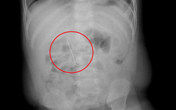 Bé trai 11 tháng khó chịu trong người, bác sĩ gắp ra thứ "đáng sợ"