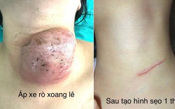Phẫu thuật nội soi đóng rò xoang lê cho hàng chục trẻ em