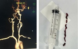 Cấp cứu đột quỵ kịp thời, phối hợp liên tuyến cứu bệnh nhân 75 tuổi