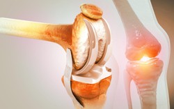 4 loại thực phẩm "ăn mòn" khớp nhanh nhất nếu lạm dụng: Toàn món khoái khẩu của nhiều người