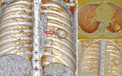 Xét nghiệm có chỉ số mang thai, cô gái ngỡ ngàng khi “thủ phạm” là ung thư tạo triệu chứng đánh lừa