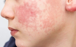 8 dấu hiệu ban đầu của "căn bệnh dễ lây lan nhất thế giới": Xuất hiện TRƯỚC cả khi phát ban, trẻ dưới 5 tuổi có nguy cơ cao nhất