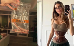 Cô gái 28 tuổi chi 362 triệu, cắt 6 xương sườn để có vòng eo con kiến - trào lưu thẩm mỹ kinh hoàng quay trở lại