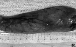 Một tháng chịu nghẹn, người phụ nữ 59 tuổi bàng hoàng khi biết thứ "đáng sợ" nằm trong cổ họng