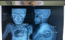 Cứu 2 bệnh nhi có cột sống vẹo như cầu thang xoắn