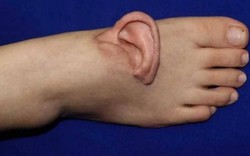 Nối lại tai đã đứt rời sau khi nuôi ở bàn chân suốt 5 tháng