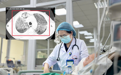 Mang theo “vi khuẩn tử thần” về từ Thái Lan, người đàn ông 35 tuổi nhập viện trong tình trạng cận kề tử vong