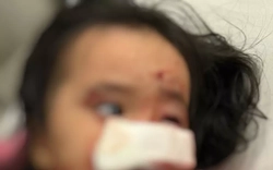 Dạo chơi cùng bố, bé gái 4 tuổi bị chó cắn nát mặt thương tâm