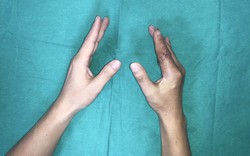 Ngón tay thủy thủ 'sống lại' sau 25 giờ đứt rời giữa tâm bão