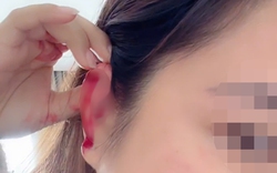 Hà Nội: Cô gái cầu cứu sau khi bị bạn cùng phòng trọ hành hung rách tai vì lấy nhầm nồi nấu ăn