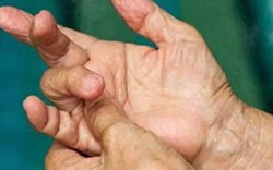 4 thay đổi ở ngón tay có thể là dấu hiệu ung thư phổi, hãy đi khám ngay!