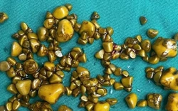 Người phụ nữ "giấu cả trăm cục vàng" trong... túi mật