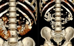 Nam thanh niên suy thận nặng ở tuổi 36: Phim chụp CT khiến bác sĩ sửng sốt
