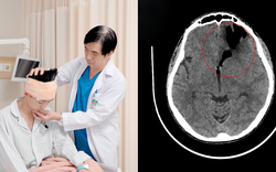 Đau đầu, chảy nước mũi, nam thanh niên phát hiện bị rò dịch não tủy