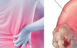 Dấu hiệu âm thầm của ung thư thận dễ bị bỏ qua