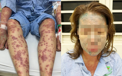 Dùng “thuốc giảm mỡ bụng, collagen”, người phụ nữ ở TP.HCM nguy kịch: Rùng mình hình ảnh tổn thương da khắp cơ thể