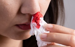 Bác sĩ cảnh báo: Cẩn trọng với những vết bầm lạ trên da!