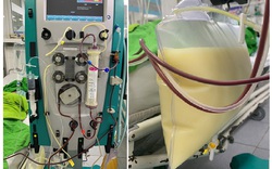 Cô gái Phú Thọ chỉ nặng 45kg nhưng mỡ máu cao gấp 37 lần, hình ảnh lọc mỡ máu trắng như sữa gây sốc