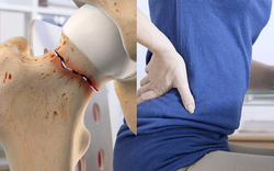 Phụ nữ mãn kinh khó tránh loãng xương: Nếu bạn không thuộc 3 nhóm sau thì xin chúc mừng!