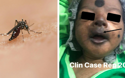 Bé trai 12 ngày tuổi mặt tím đen vì nhiễm virus Chikungunya có thể "phá hủy nội tạng"