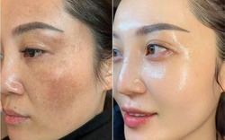 Sai lầm tồi tệ khi dùng Retinol suýt banh mặt, từ đáy lòng khuyên bạn đừng dẫm vào "vết xe đổ" này