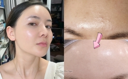 Thạc sĩ 36 tuổi chia sẻ hành trình trị mụn ẩn khoa học: Da sần sùi hóa láng mịn chỉ nhờ hiểu đúng