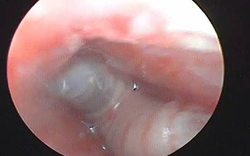 Thấy trẻ bị đau tai kèm chảy máu, gia đình đưa đi khám thì sốc nặng