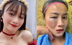 Hotgirl bóng đá Hoàng Thị Loan để lộ vùng mắt sưng vù sau pha va chạm trên sân bóng khiến fan cực xót