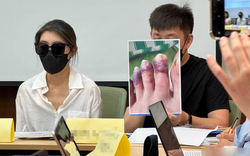 Đi hút mỡ, người phụ nữ phải chạy thận nhân tạo suốt đời