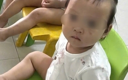 Tình trạng sức khỏe bé gái 1 tuổi bị bầm tím mặt khi gửi nhà trẻ ở Bắc Ninh