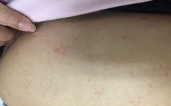 Nguy hiểm từ tự ý dùng thuốc, gia tăng ca sốc phản vệ