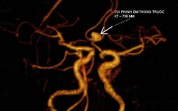 Đau đầu kéo dài, cô gái Hà Nội đi khám phát hiện phình mạch não, suýt đột quỵ