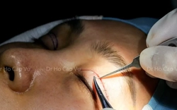 Thẩm mỹ 'chui' dùng người không bằng cấp tiêm filler, cắt mí trái phép cho khách