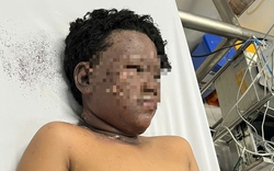 Bé trai với gương mặt cháy đen tự chạy về nhà để người thân đưa đi bệnh viện