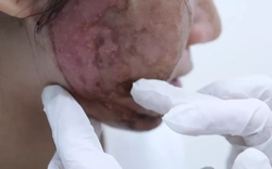 Dồn dập tai biến cao điểm làm đẹp ‘cấp tốc’ mùa Tết