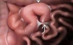 Tắc ruột do dây chằng - biến chứng nguy hiểm sau phẫu thuật ổ bụng không thể chủ quan