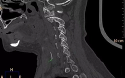 Những 'mẹo' chữa hóc xương phản khoa học, có thể gây chết người