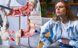 Không phải di truyền, chính những món quen thuộc này có thể đang "nuôi lớn" ung thư đại trực tràng ở phụ nữ trẻ