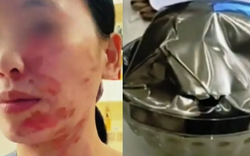 Chiếc bát bất ngờ phát nổ khiến người phụ nữ bỏng toàn thân: 3 loại bát nên cân nhắc khi đựng đồ nóng kẻo tự hại thân