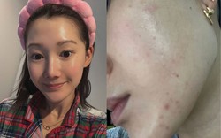 Beauty editor 29 tuổi, da tốt mà vẫn toang vì mụn: Hành trình “cứu” da chỉ với 6 sản phẩm nền tảng